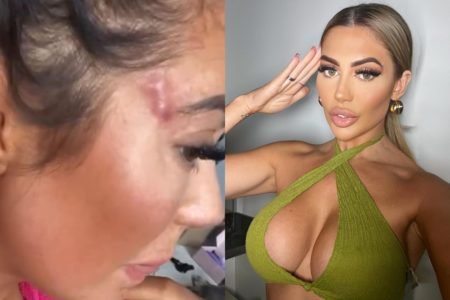 Montagem que mostra a cicatriz da empresária Chloe Ferry, que fez uma cirurgia na região dos olhos e terminou com uma inflamação. Chloe é uma mulher branca e jovem, com cabelo liso loiro, e olhos auiz. Na foto, usa um top verde. - Metrópoles