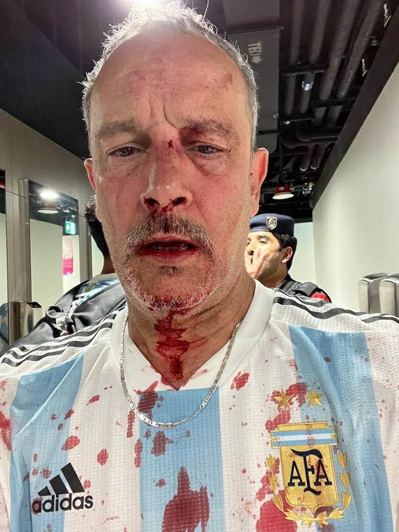 Homem branco com camisa da Argentina mostrando rosto machucado e ensanguentado 