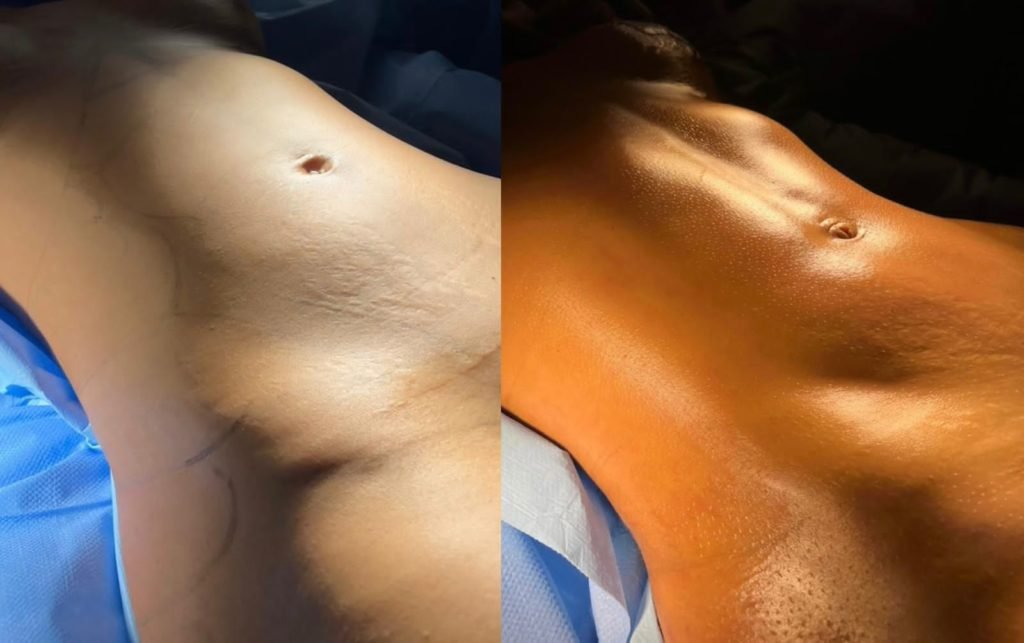 Antes e depois de Mileide Mihaile