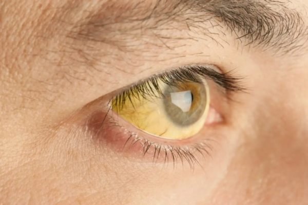 Olhos amarelados: 10 principais causas, sintomas e o que fazer