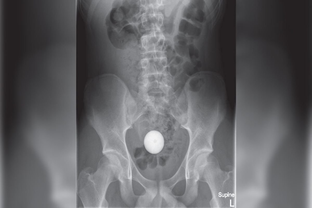 Raio-x da intura do rapaz mostra objeto circular dentro do intestino