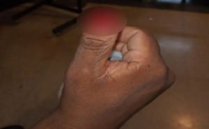 Imagem colorida mostra a mão do policial militar. A ponta do polegar, onde agressão ocorreu, está borrada digitalmente