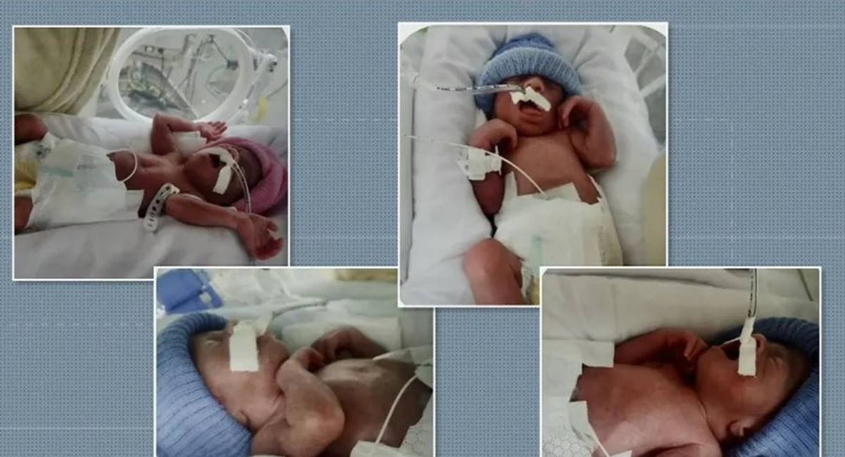 montagem com quatro fotos de bebês prematuros - metrópoles