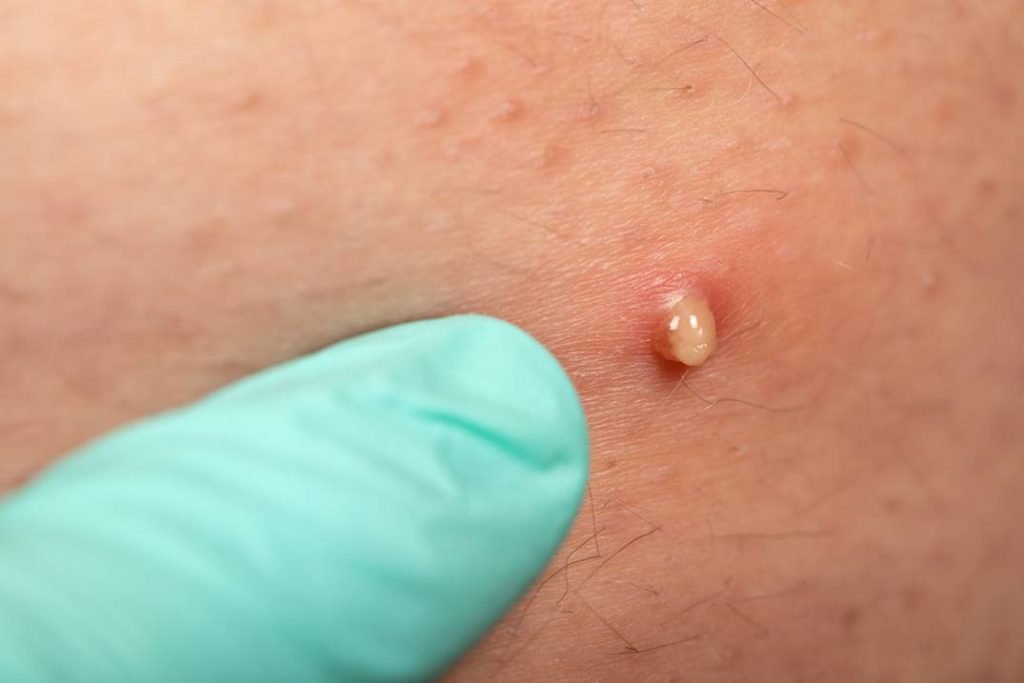 Imagem mostra dedo com luva apontando para uma foliculite na pele - Metrópoles