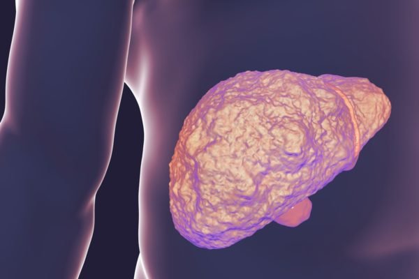 Ilustração colorida de um fígado humano com cirrose - Metrópoles
