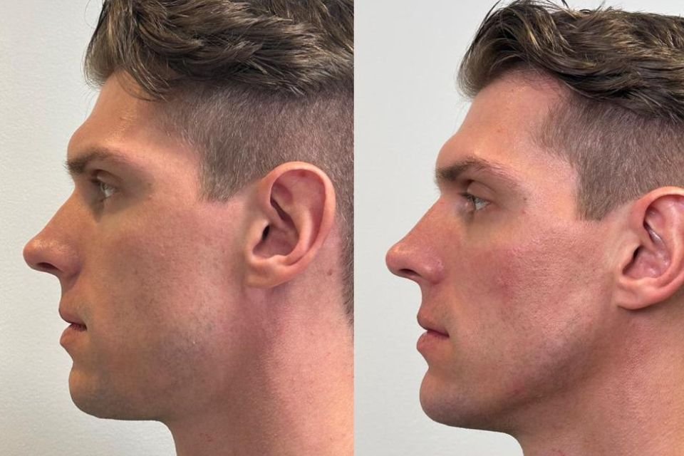Ex-BBB23 Cristian Vanelli faz harmonização facial. Saiba o valor |  Metrópoles