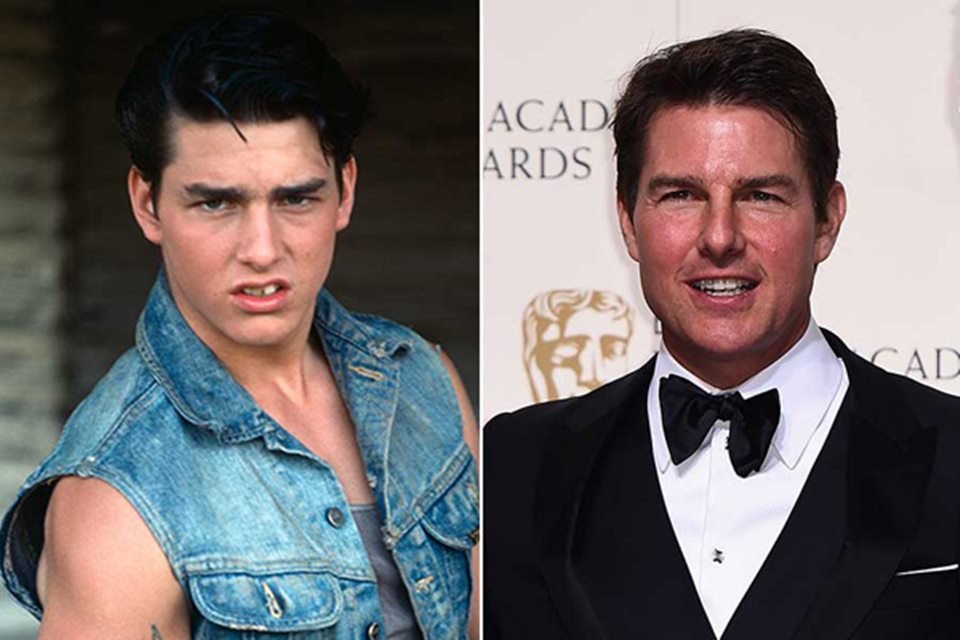 Montagem colorida de Tom Cruise antes e depois de fazer procedimentos estéticos - Metrópoles 