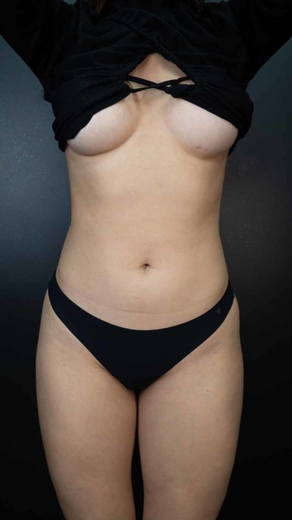 Ex-BBB Eslovênia mostra resultado de lipo LAD