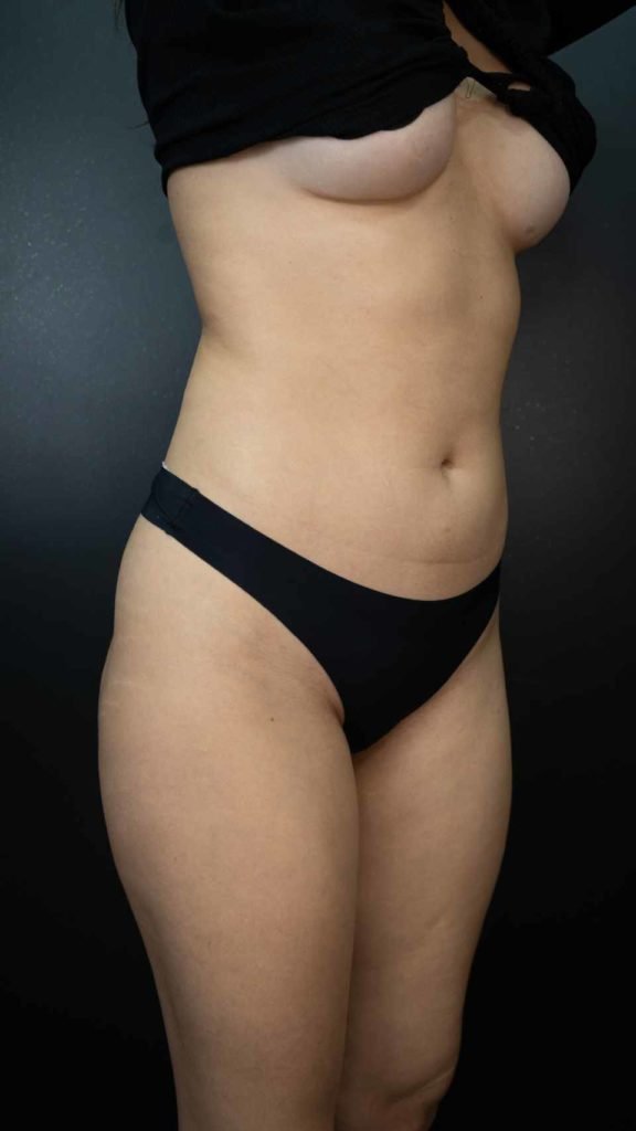 Ex-BBB Eslovênia mostra resultado de lipo LAD