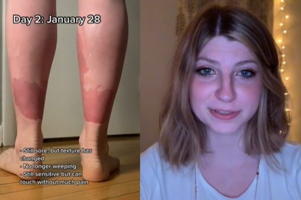 Imagem de Becca, que sofre com doença rara de pele - Metrópoles
