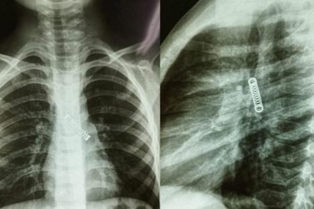imagem de raio-x de mola no pulmão do garoto - Metrópoles