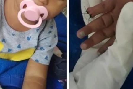 Montagem com o dedo de uma criança que foi amputado por erro médico em São Gonçalo (RJ) - Metrópoles