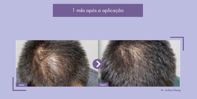 Tratamento capilar com o Rigenera