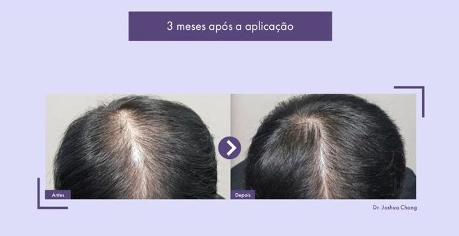 Tratamento capilar com o Rigenera