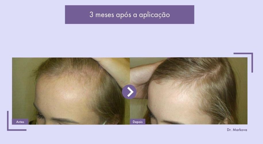Tratamento capilar com o Rigenera