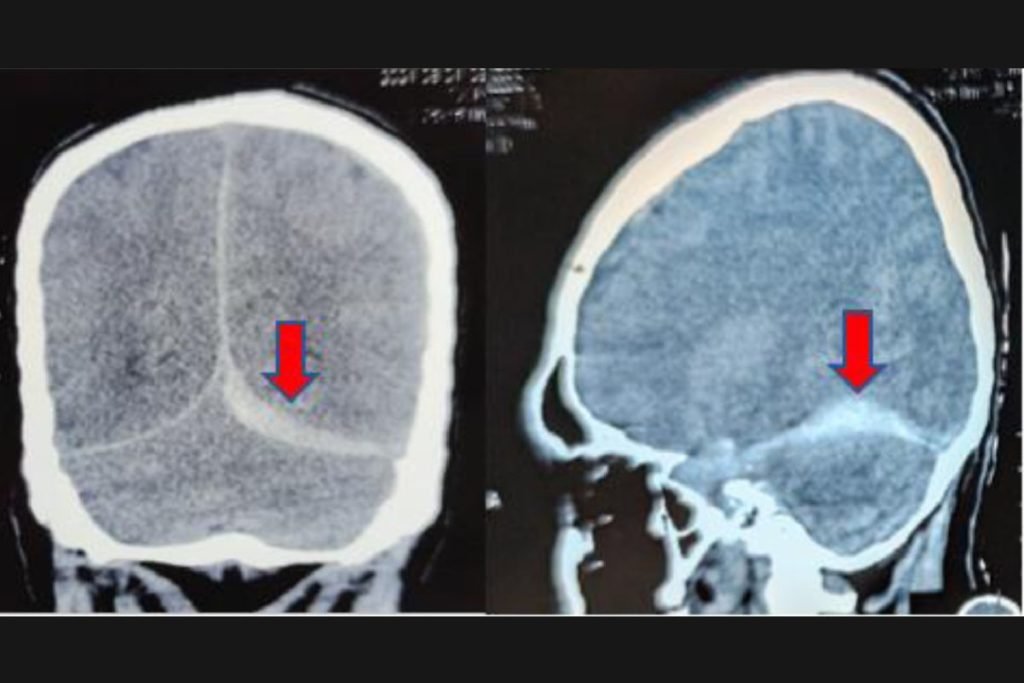 Imagem de tomografia mostra aneurisma - Metrópoles