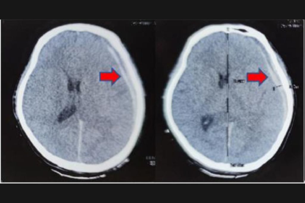 Imagem de tomografia mostra aneurisma - Metrópoles