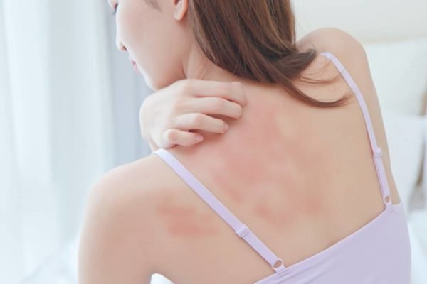 Mulher de costas com reação alérgica enquanto coça urticárias
