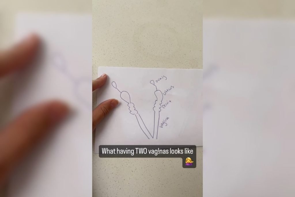 Desenho que explica a condição da mulher que tem duas vaginas uma do lado da outra