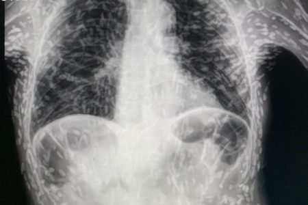 Imagem de radiografia mostra tórax de paciente com cisticercose - Metrópoles