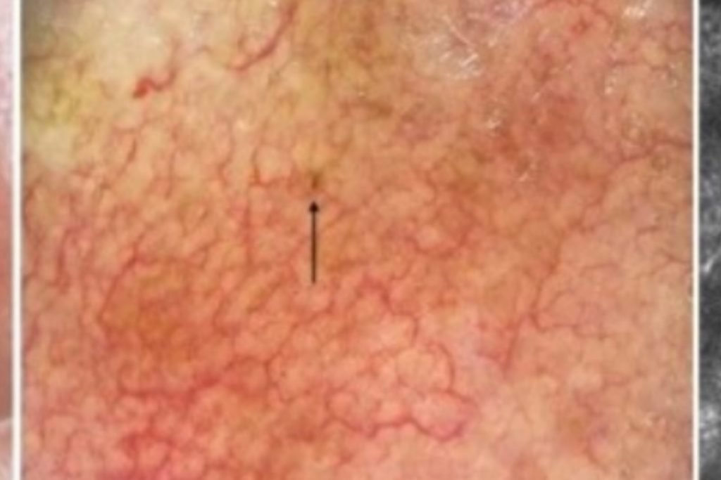 Smallest melanoma in the world is identified, it has 0.65mm, less than a strand of hair
