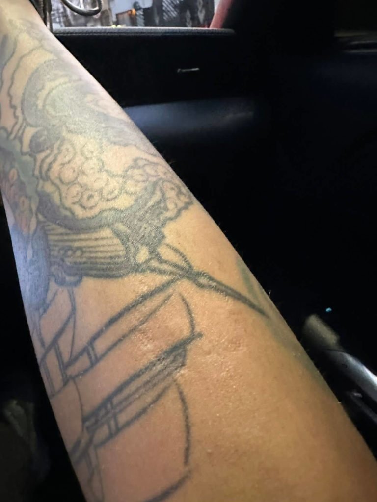 Hematomas de Tati Zaqui em foto apresentada por ela para a polícia ao denunciar Thomaz Costa por agressão