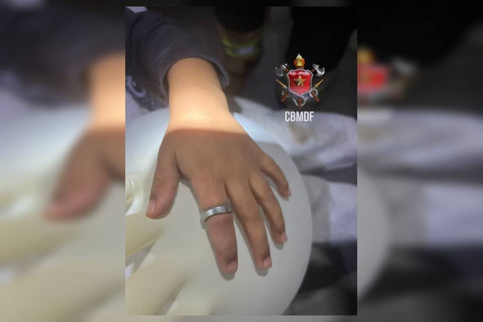 Anel preso no dedo de uma criança