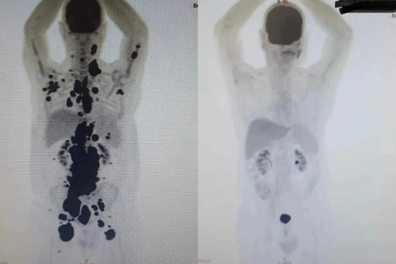 Imagem em preto e branco mostra antes e depois de corpo de paciente com câncer CAR-T - Metrópoles