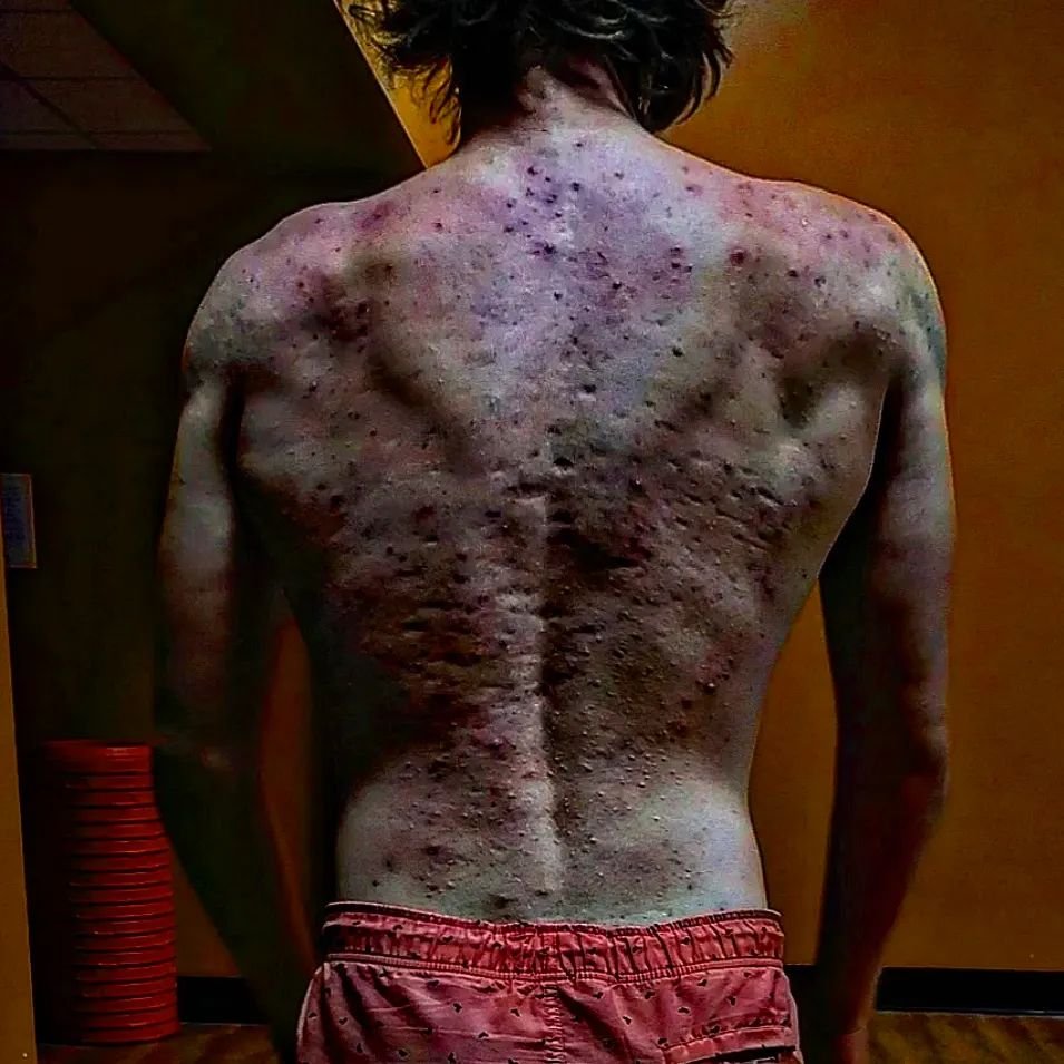 Esteroides deixam jovem com acne tão grave que ele não podia se vestir, anabolizante, espinhas - Metrópoles