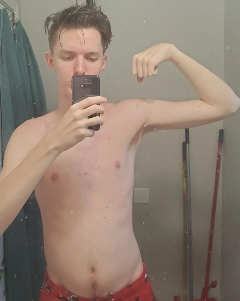 Esteroides deixam jovem com acne tão grave que ele não podia se vestir, anabolizante, espinhas - Metrópoles