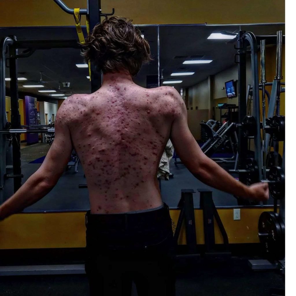 Esteroides deixam jovem com acne tão grave que ele não podia se vestir, anabolizante, espinhas - Metrópoles