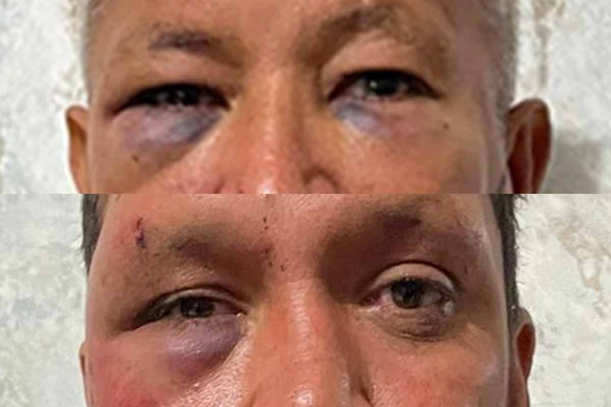 agressao-PMS-olhos