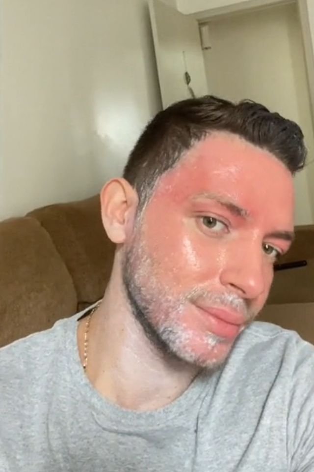Peeling de fenol