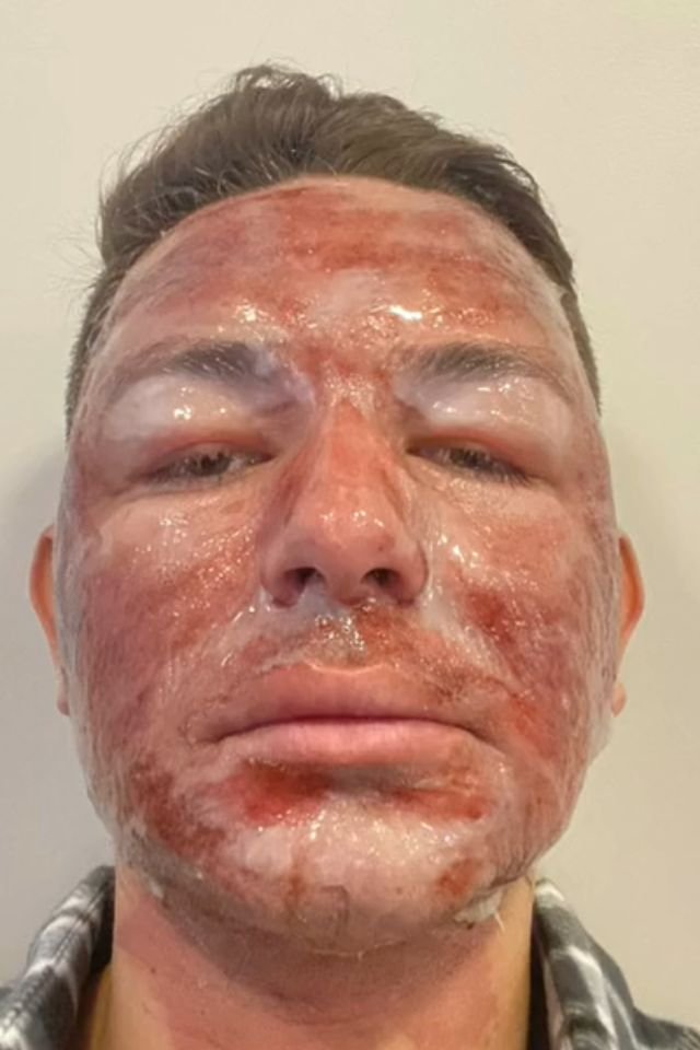 Peeling de fenol