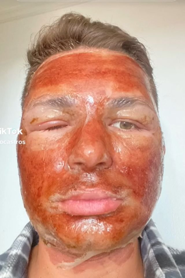 Peeling de fenol