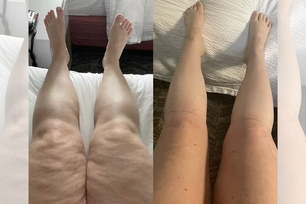 Lipedema: veja como identificar a doença e os tipos de tratamento