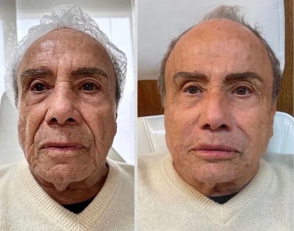 Na foto, um antes e depois do ator Stenio Garcia - Metrópoles