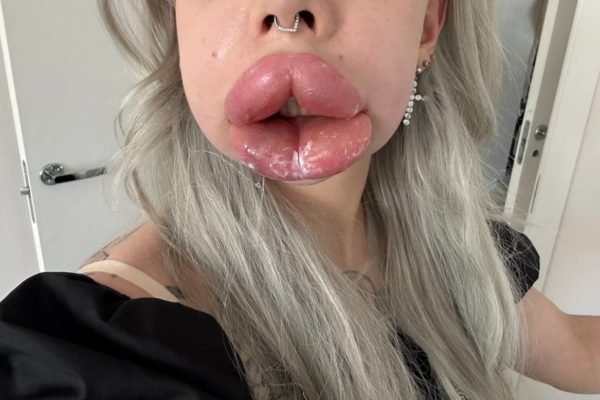 Mulher tenta reduzir lábios e alergia faz eles dobrarem de tamanho Influencer russa teve alergia e inchaço após procedimento e teve que ser atendida em emergência no hospital