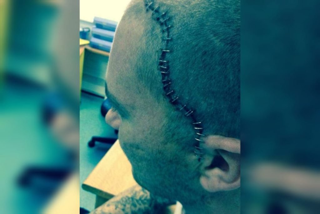 Imagem colorida de homem com a cabeça cheia de grampos por conta de um tumor no cérebro - Metrópoles