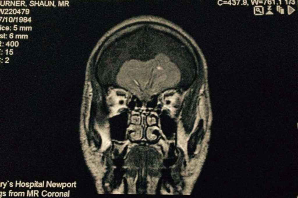 Homem descobre que desejo sexual extremo era sintoma de câncer de cérebro Inglês tinha um tumor do tamanho de uma laranja na cabeça. A mãe dele também teve câncer de cérebro anos depois