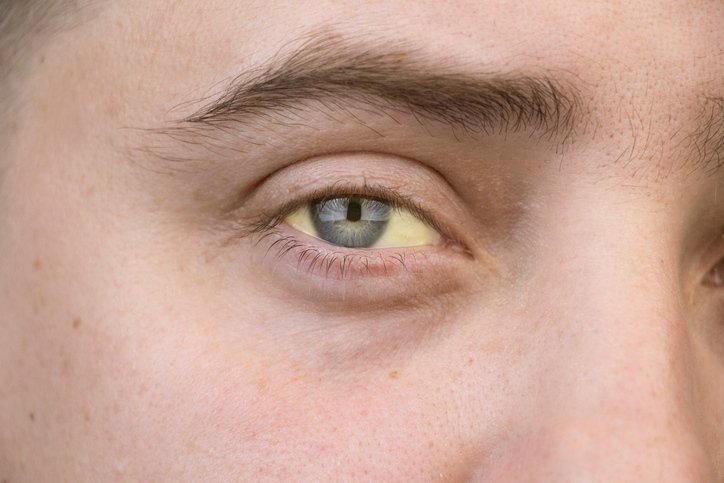Foto mostra close-up de olho de um homem com tonalidade amarelada - Metrópoles