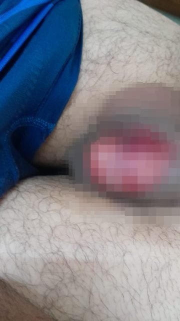 Foto borrada do testículo de homem vítima de violência no Entorno do DF