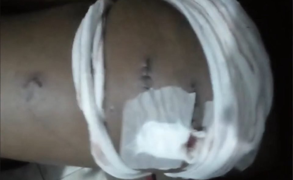 Foto colorida de uma perna com lesões e pontos cobertos por curativos brancos - metrópoles