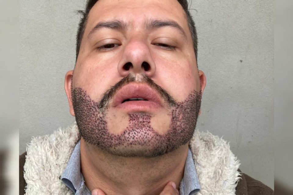 Transplante de barba t cnica cria pelos faciais com cabelo