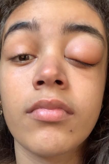 Foto de adolescente com olho inchado - Metrópoles