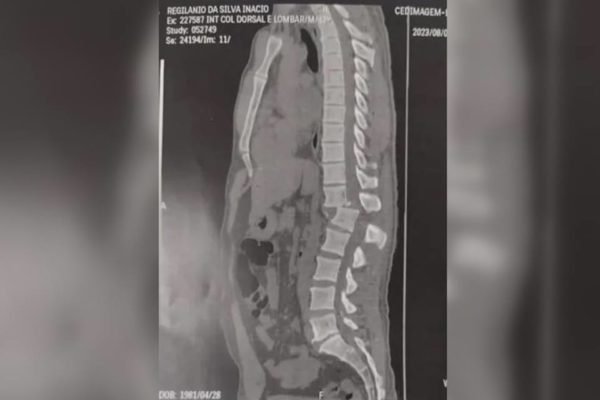 Imagem mostra raio-x da coluna de homem que se feriu em acidente registrado em academia do Ceará - Metrópoles