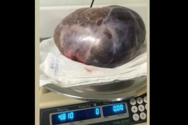 imagem colorida tumor 5 kg mulher mg