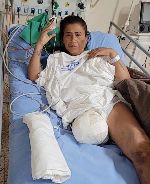 MC Kátia deitada em maca coberta com lençol de hospital mostra perna amputada enfaixada - metrópoles