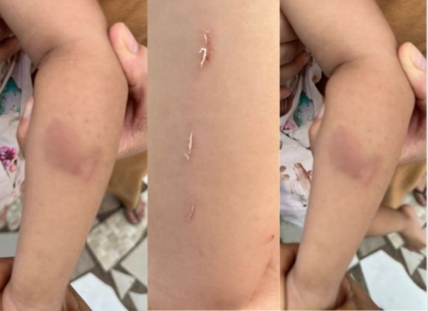 Imagem colorida de marcas de agressão em uma criança - Metrópoles