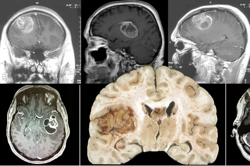 Imagem de tumor cerebral - Metrópoles